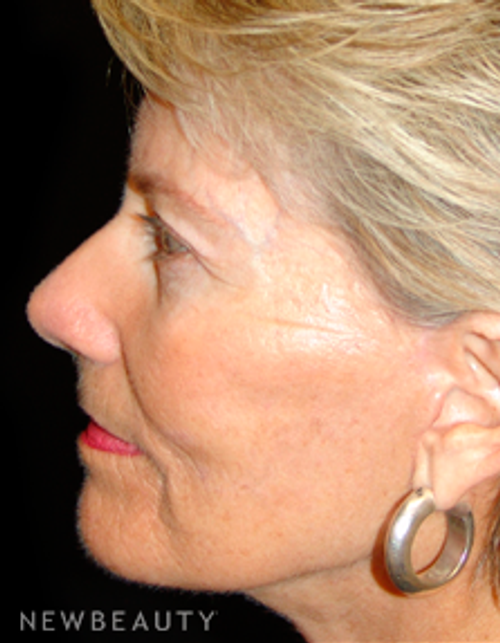Dr. Mokhtar Asaadi Eyelid, Lift Facelift - After
