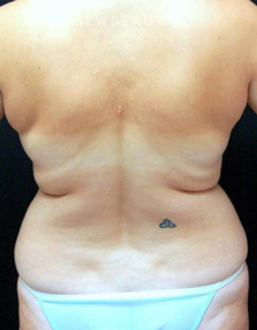 Dr. Mokhtar Asaadi - VASER Liposuction - Before