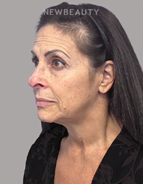 Dr. Dilip Madnani - Facelift - 45283915 - Before