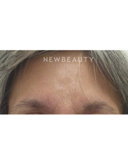 Dr. Kally Papantoniou - Injectables and Fillers - After