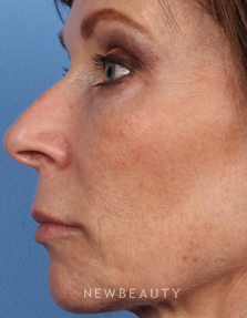 Dr. Kelly Bomer - Fillers - After