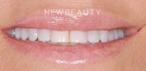 Dr. Salvator La Mastra - Smile Makeover- 46106595 - Before
