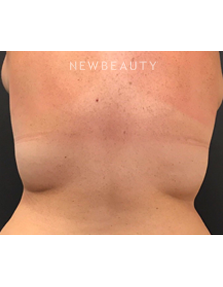 Dr. Janet Allenby - CoolSculpting - After