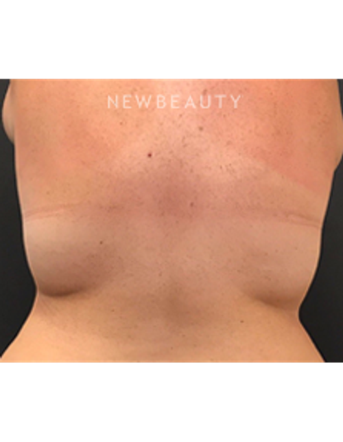 Dr. Janet Allenby - CoolSculpting - After