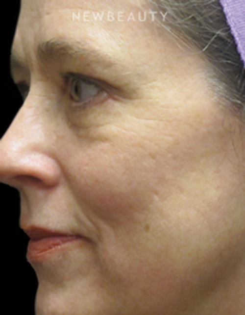 Dr. Jody Levine - Improved Tone and Texture - After