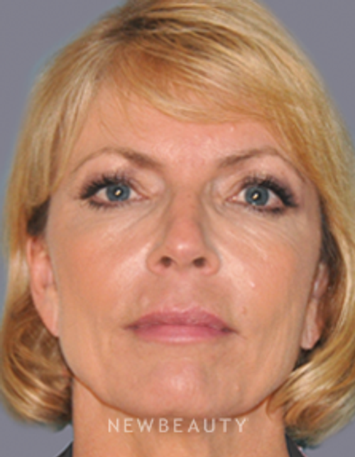 Dr. Alan Durkin Facelift with Fat Transfer - Before