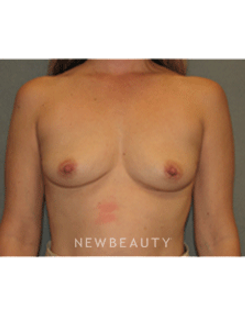 Dr Sean Simon Breast Augmentation - Before