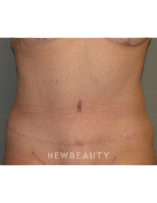 Dr Sean Simon Tummy Tuck, Lipo - After