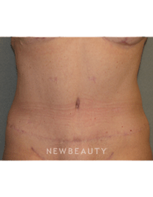 Dr Sean Simon Tummy Tuck, Lipo - After