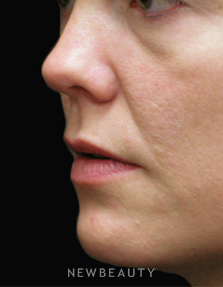 Dr. Jody Levine - Lip Enhancement - Before