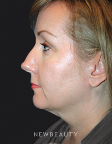 Dr. Kelly Bomer Facelift, Neck lift - Before