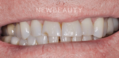 Dr. Salvator La Mastra – Smile Makeover – 46107191 - Before
