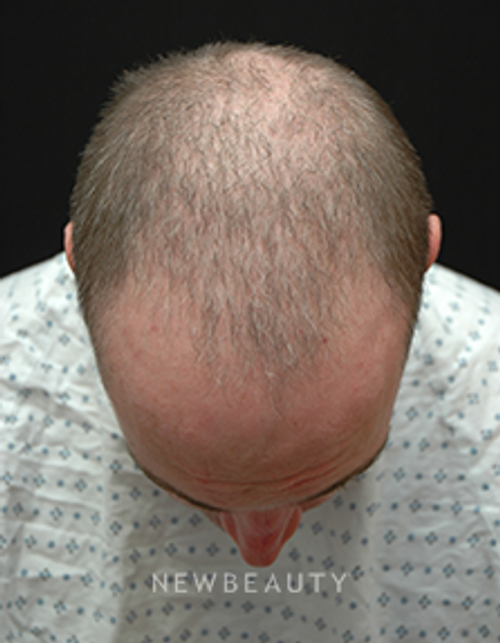 Dr. Jeffrey B. Wise - Hair Loss - Before