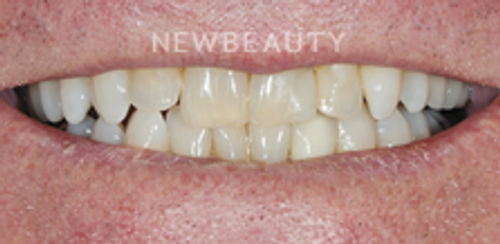 Dr. Salvator La Mastra - Smile Makeover -46106806 - Before