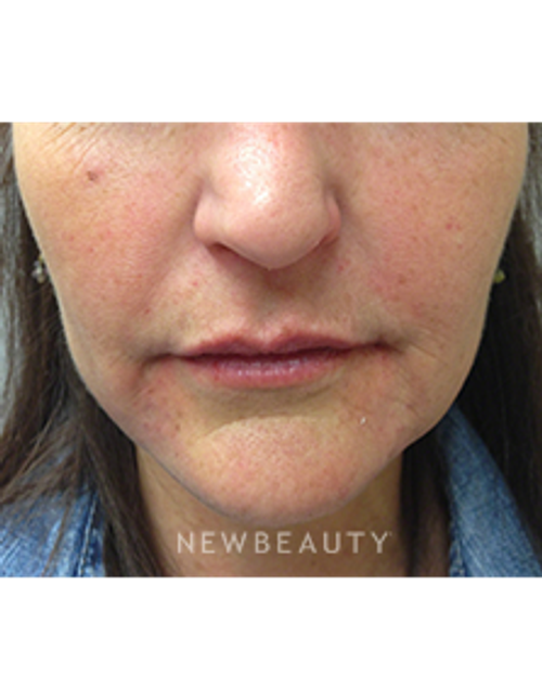 Dr. Kally Papantoniou - Liquid Facelift - After