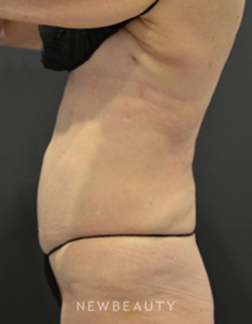 Dr. Aviva Preminger - CoolSculpting - After