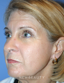 Dr. Kelly Bomer, Injections/Liquid Lift, Lip Augmentation - Before