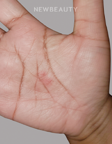 Dr. Anna Chacon – Hand Dermatitis - 34277661 - After