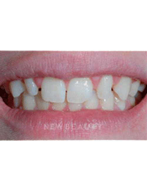 Dr. Guy Lewis Veneers - Before