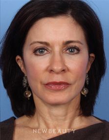 Dr. Kelly Bomer - Facial Rejuvenation - After