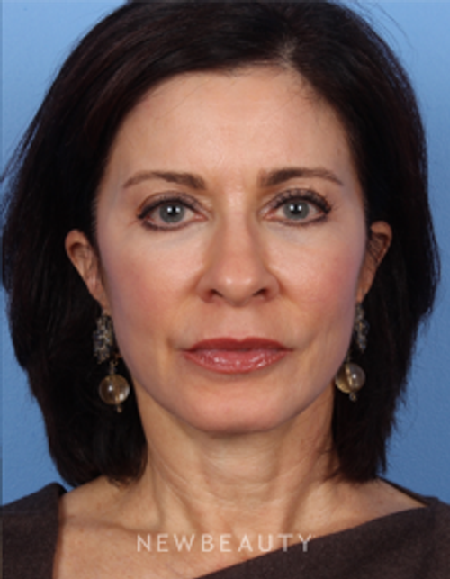 Dr. Kelly Bomer - Facial Rejuvenation - After