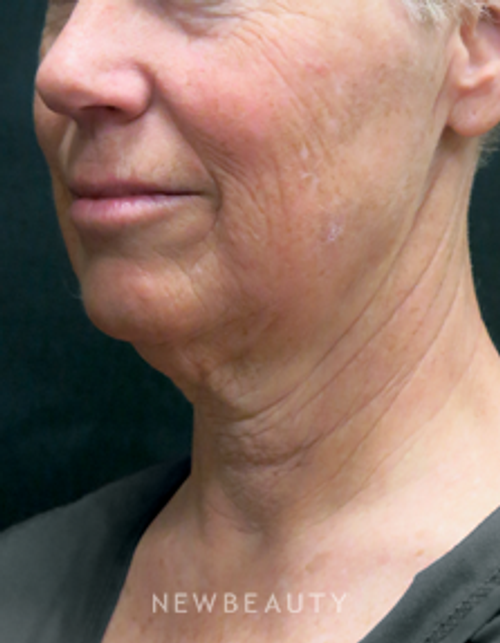 Dr. Elie Levine - Facelift, Necklift, Chin Augmentation - Before