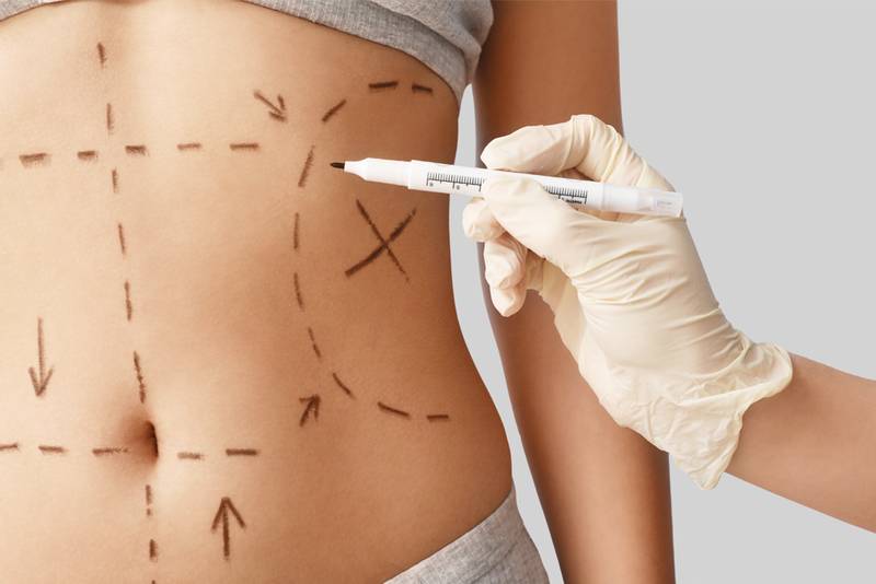 woman getting plastic surgery markups on abdomen
