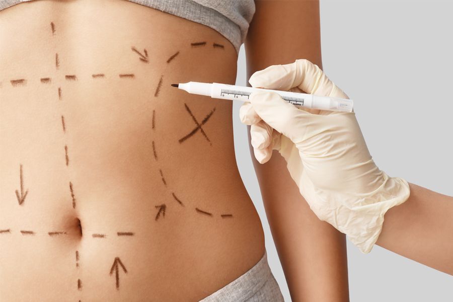 woman getting plastic surgery markups on abdomen