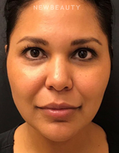 Dr. Janet Allenby - Liquid Facelift - After