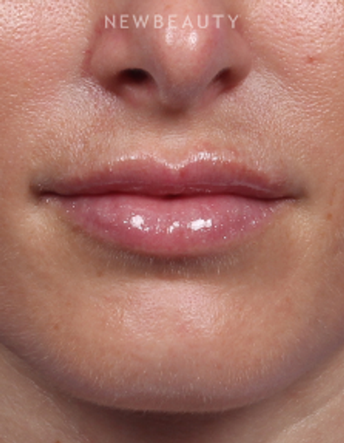 Dr. Kelly Bomer - Lip Filler - After