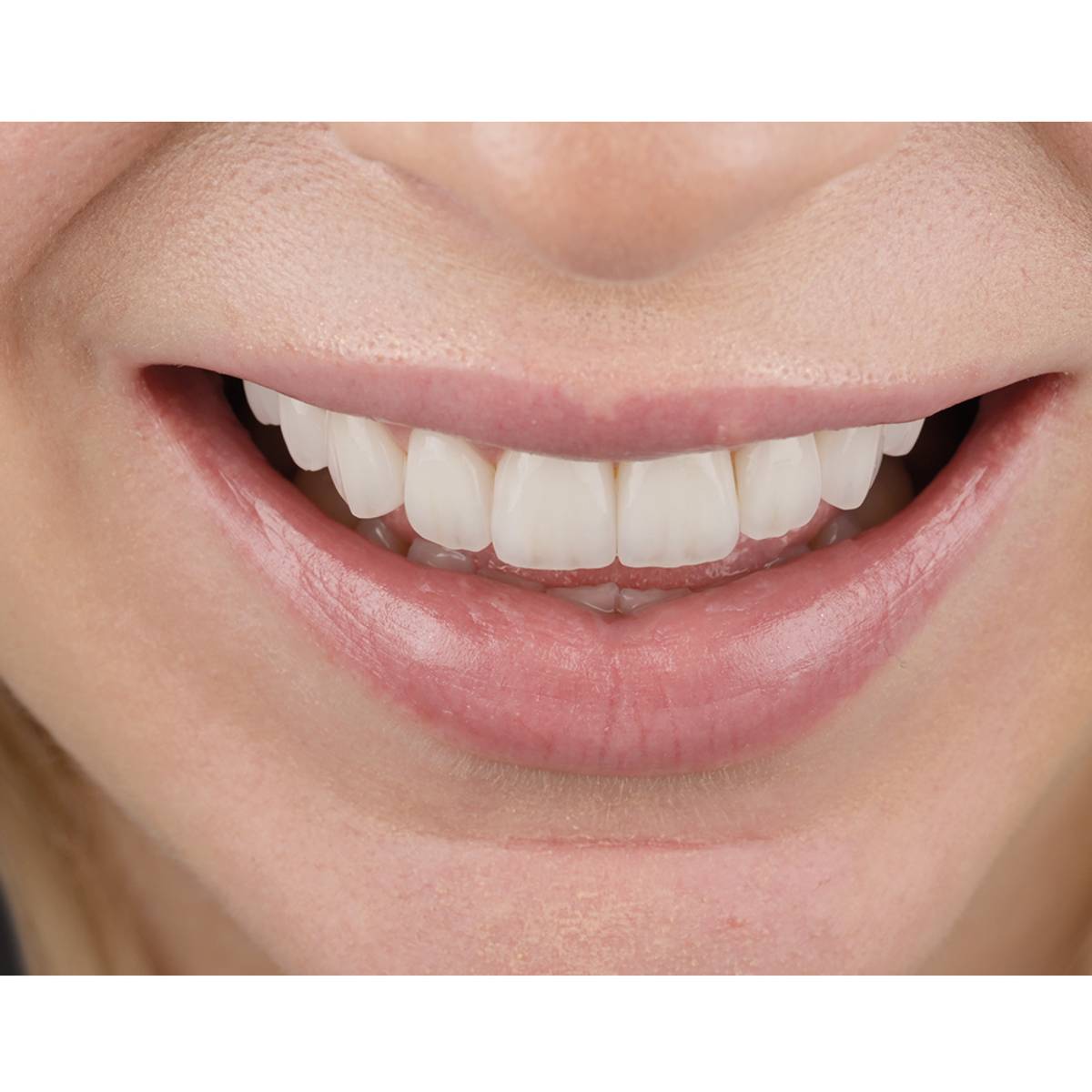 veneers after