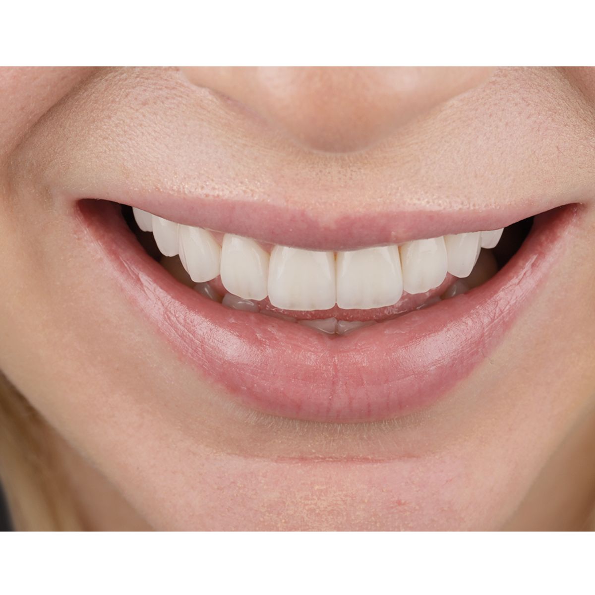 veneers after