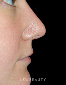 Dr. Lee Ann M. Klausner - Revision Rhinoplasty - After
