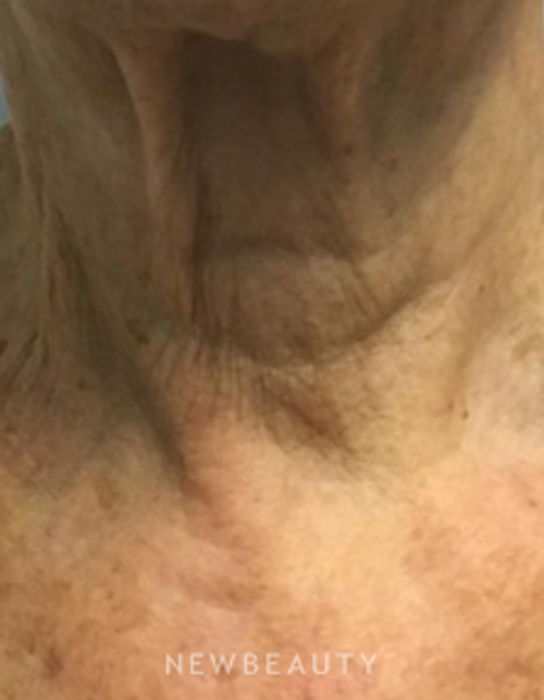 Dr. Marina Peredo - Botox - Before