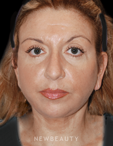 Dr. Roman Rayham - Defining Beauty - After