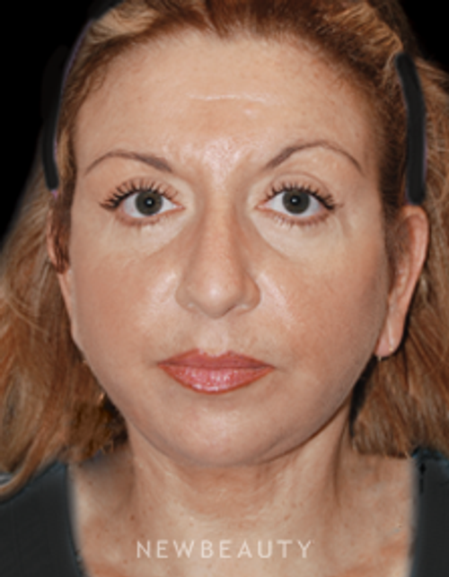 Dr. Roman Rayham - Defining Beauty - After