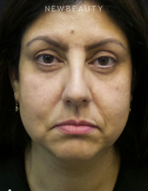 Dr. Adam Summers - Facelift - Before