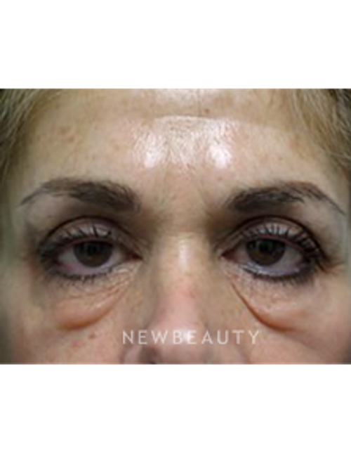 Dr. B. Aviva Preminger - Lower Bleph - Before