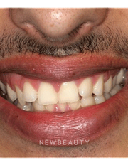 Dr. Joseph Field - Invisalign & Teeth Whitening - Before