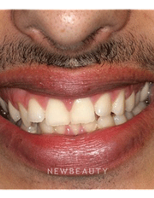 Dr. Joseph Field - Invisalign & Teeth Whitening - Before