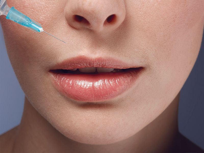 lower face receiving facial filler