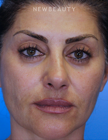 Dr. Ava Shamban - Facial Rejuvenation - After