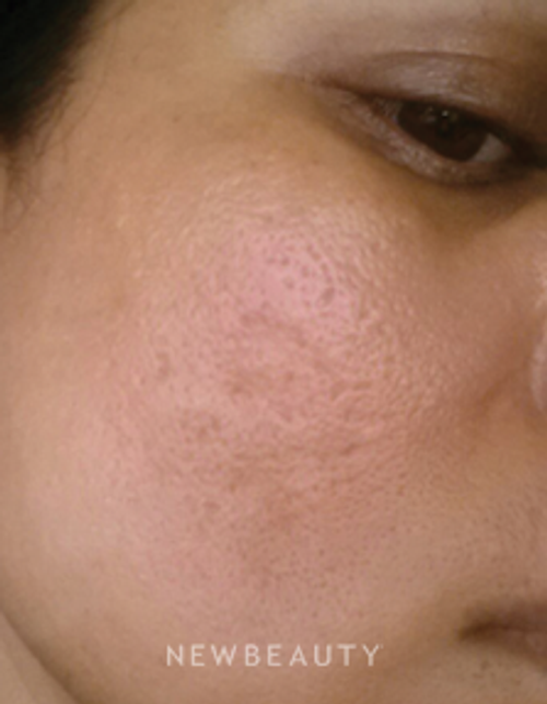 Dr. Jody Levine - Acne Scar Treatment - After
