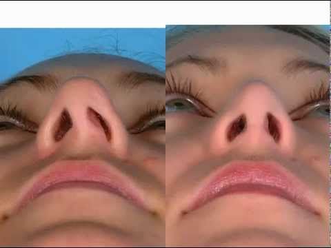 Dr. David Kim – Rhinoplasty – The Nasoseptal L Strut