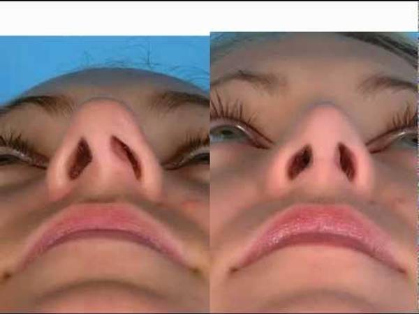 Dr. David Kim – Rhinoplasty – The Nasoseptal L Strut