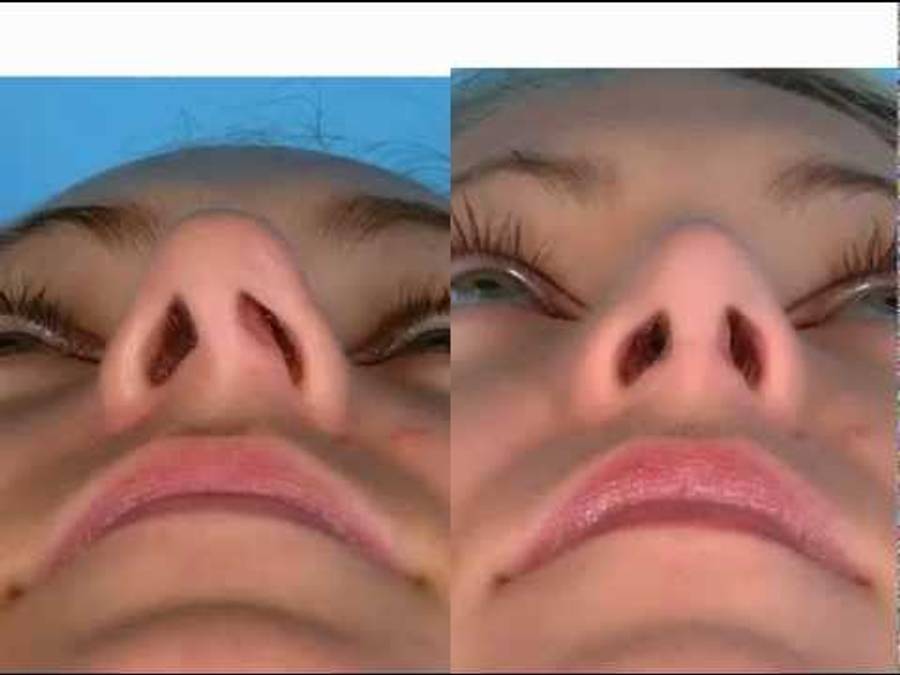 Dr. David Kim – Rhinoplasty – The Nasoseptal L Strut