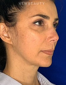 Dr. Dilip D. Madnani - Facelift - After
