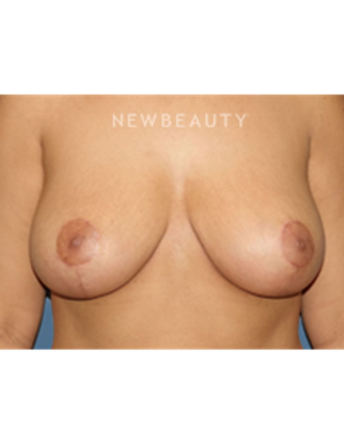 Dr. Bryan Gawley - Breast Augmentation - After