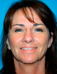 Dr. Kelly Bomer Liquid Facelift - Before