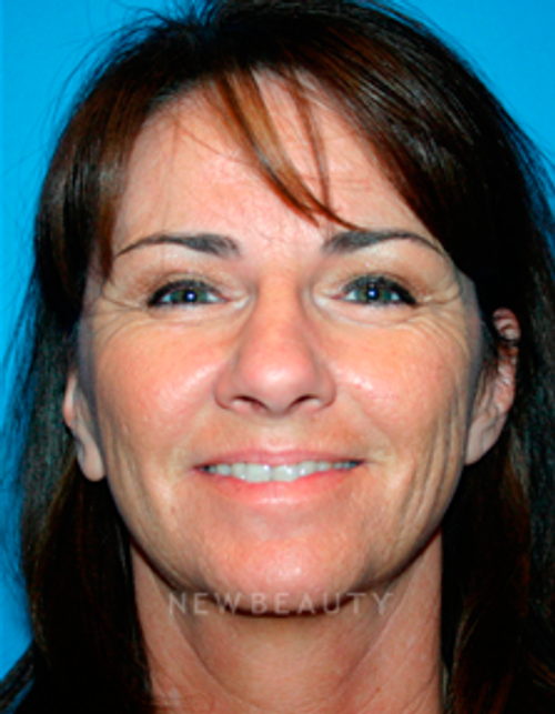 Dr. Kelly Bomer Liquid Facelift - Before